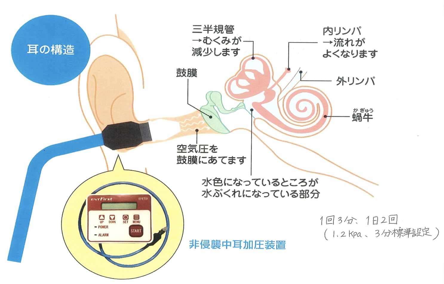 非侵襲的中耳加圧装置について