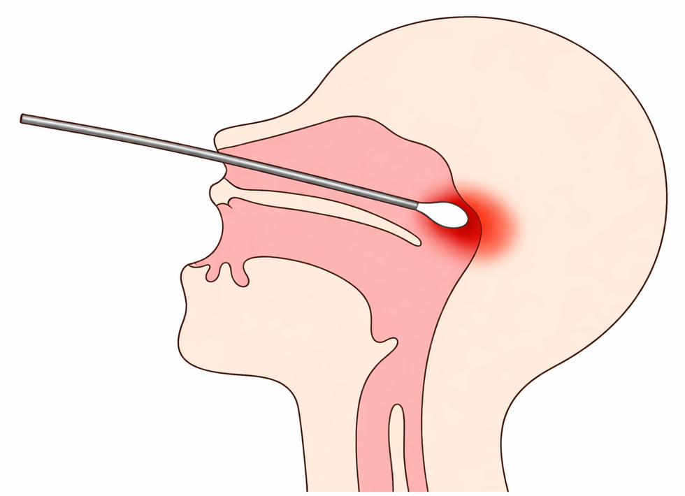 上咽頭擦過療法（Bスポット療法・EAT療法）